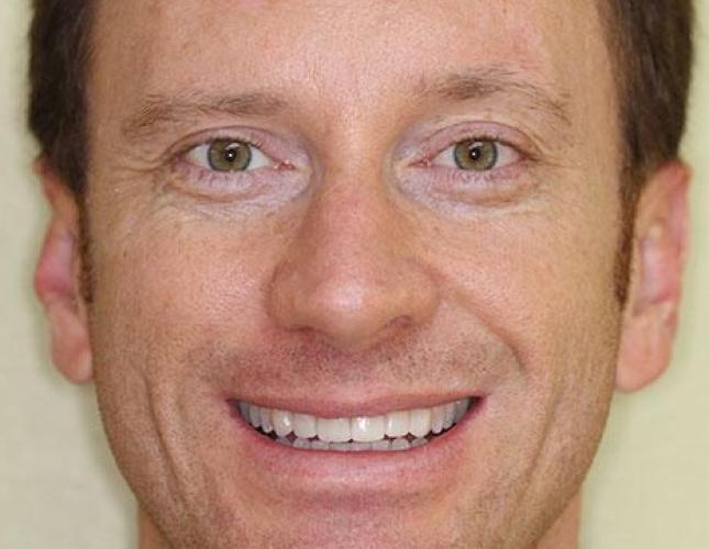 Veneers after Veneers after