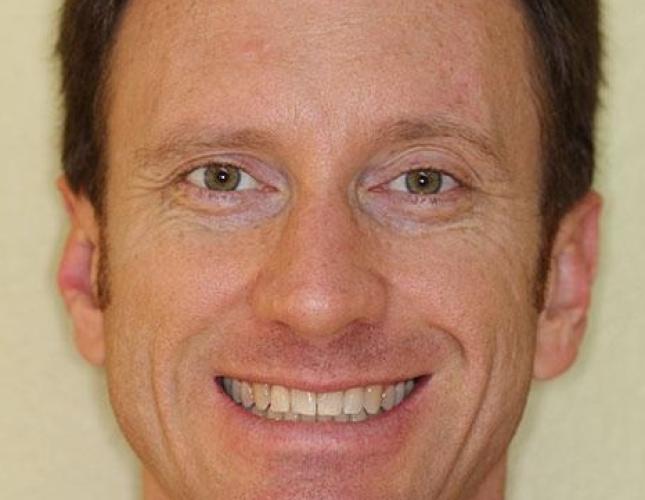 Veneers before Veneers before